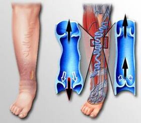Durchblutung im Bein bei Krampfadern