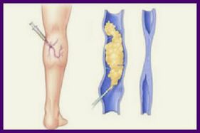 Die Sklerotherapie ist eine beliebte Methode, um Krampfadern an den Beinen loszuwerden