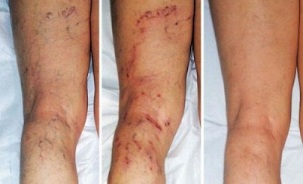 Symptome von Krampfadern in den Beinen