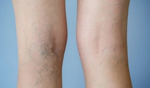 Anzeichen von Krampfadern in den Beinen bei Frauen