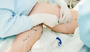 Methoden zur Behandlung von Krampfadern an den Beinen bei Frauen